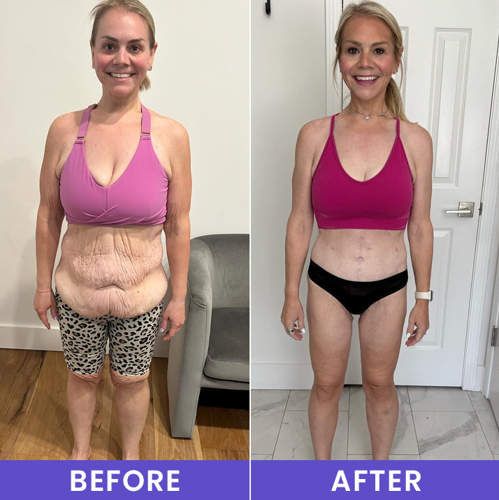 🔥LAST DAY 60% OFF-LIMETOW® Tighten & Smooth Belly Firming Cream-A01